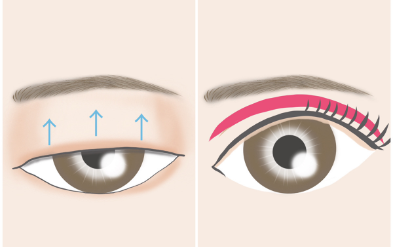 眼瞼下垂＋全切開法二重術